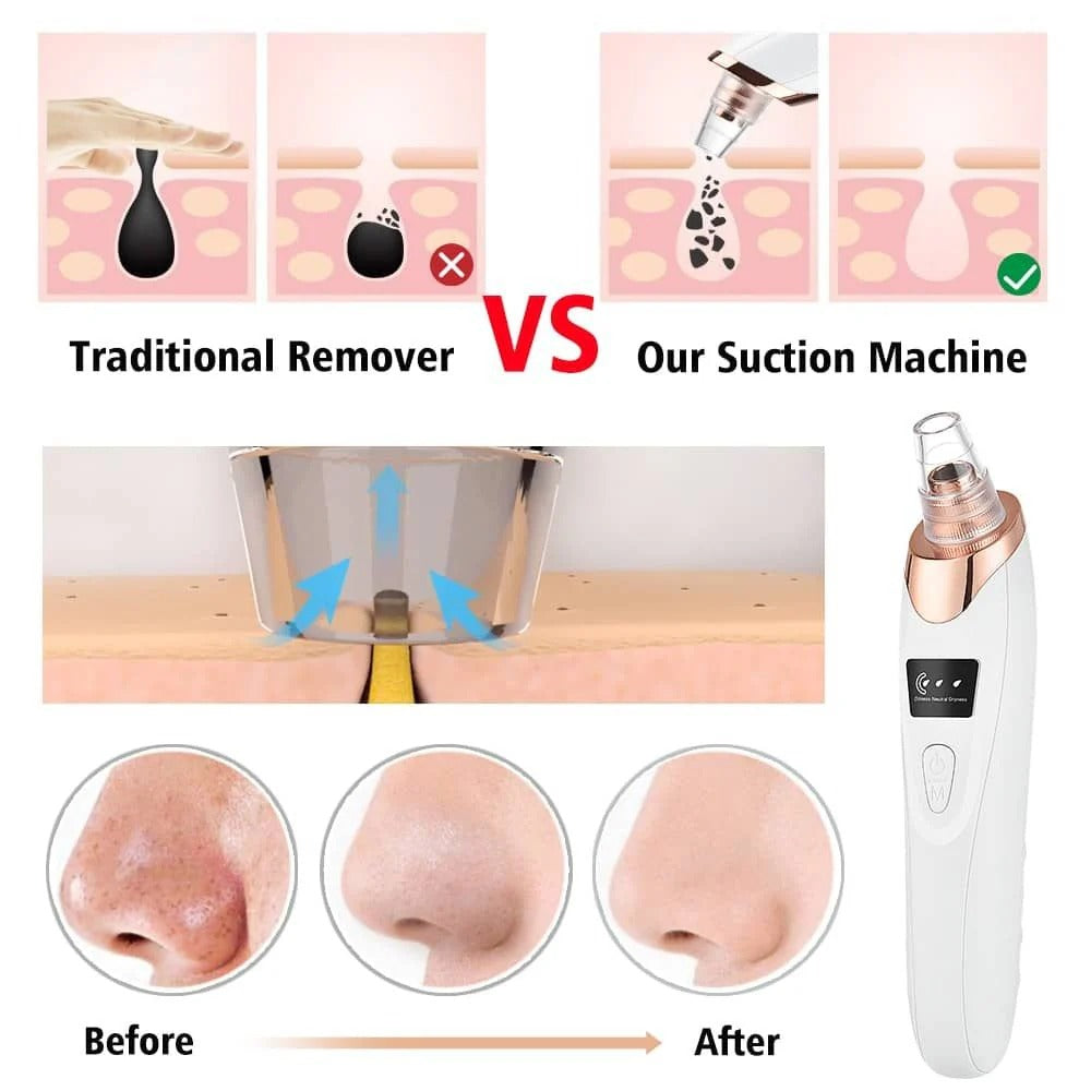 5-Head Electric Blackhead Remover Vacuum